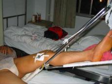 北京301骨科經典限制級課件------創傷系列1