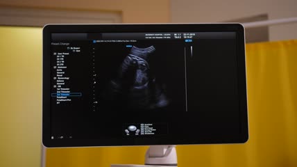 监视器上的超声波扫描特写实拍