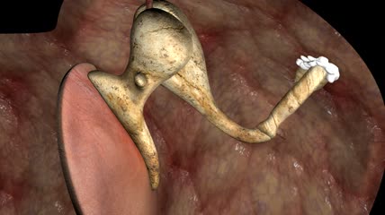 3D手术治疗耳硬化症素材